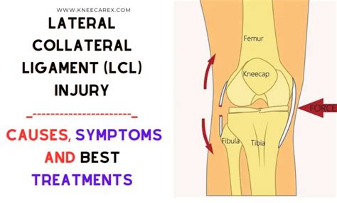 Lateral Collateral Ligament (LCL) Injury: Best Guide 2024