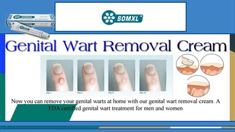 Genital Wart Removal Cream | Wartcream by Wart Cream - Issuu