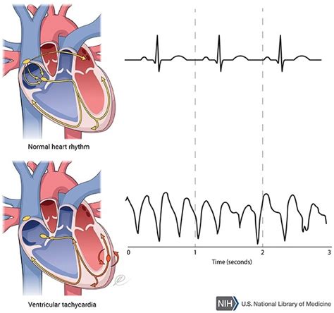 Adiposis dolorosa: MedlinePlus Genetics | Ventricular tachycardia, Genetics, Rare genetic disorders