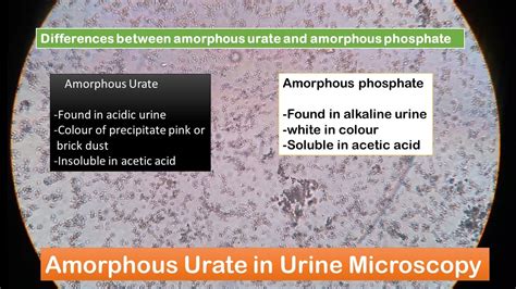 Amorphous Urates In Urine