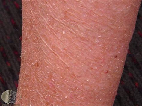 hypothyroid skin rash - pictures, photos