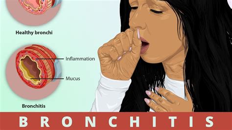 BRONCHITIS- Signs and Symptoms and Treatment - YouTube