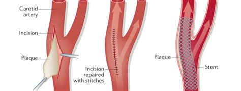 Complications of Carotid Endarterectomy in the Postanesthesia Care Unit