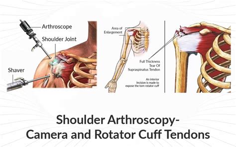 Rotator Cuff Surgery and Recovery : Shoulder Surgery