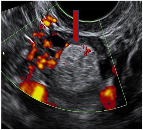 Dermoid Ovarian Cyst Ultrasound