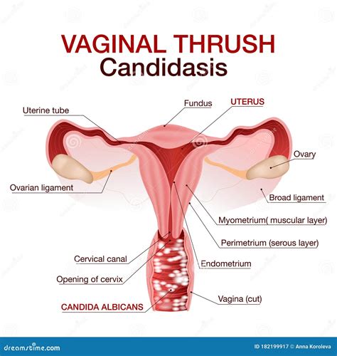 Vaginal Infection, Venereal Disease Concept. Ginecological Disorder. Zoom Circle Showing Problem ...