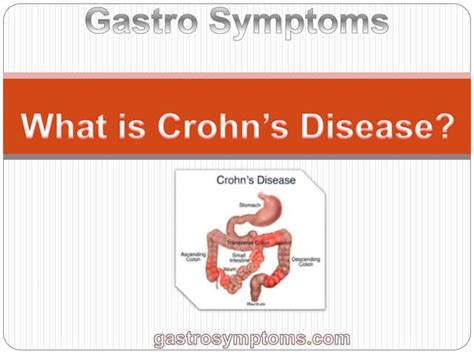 What is Crohns Disease | PPT | Free Download