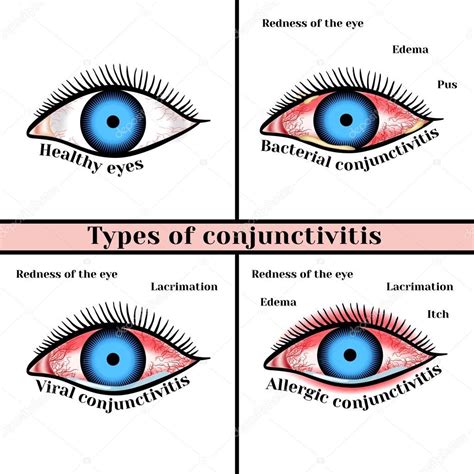 Baixar - Tipos de conjuntivite. Doenças inflamatórias dos olhos ...