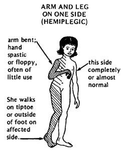 stimr.com: Hemiplegia & the OT role