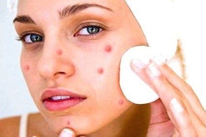 HOME REMEDIES TO ELIMINATE PIMPLES NATURALLY - Health GadgetsNG