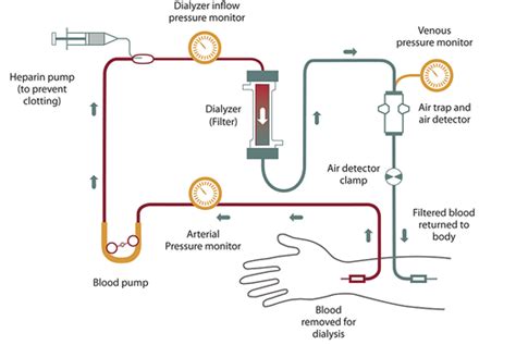 The Difference Between Hemodialysis and Peritoneal Dialysis