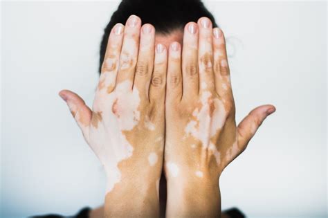 Light and White Skin Patches? All You Need to Know About Vitiligo! - GOQii