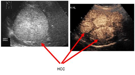 Liver Cancer Ultrasound