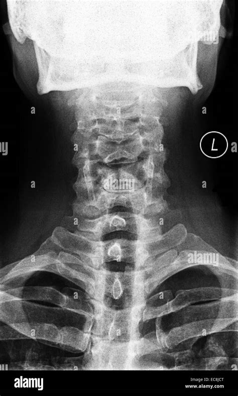 X ray of cervical spine arthritis - fitymaximum