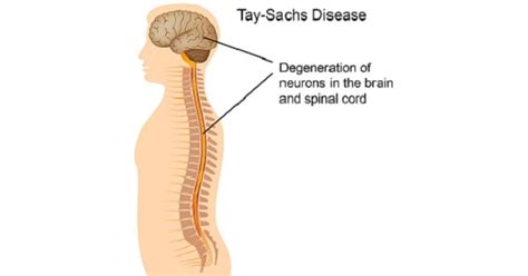 Tay-Sachs disease - New