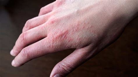 Psoriasis: Causes, Symptoms, Types & Treatment - Health Blog