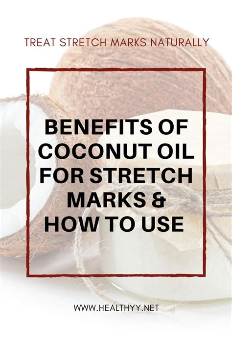 Stretch marks coconut oil – Artofit