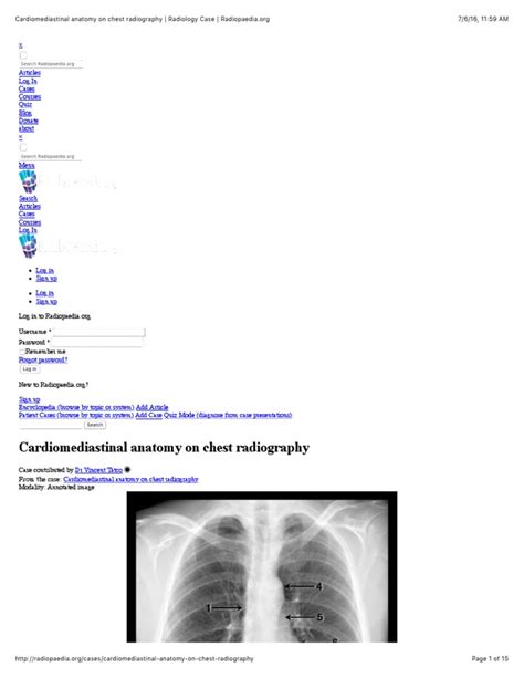 Cardiomediastinal anatomy on chest radiography | Radiology Case ...