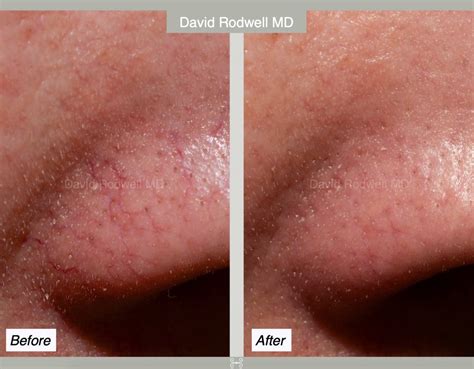 IPL Laser Treatment Charleston | Dr. David Rodwell