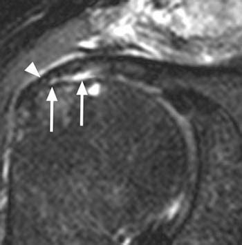 Supraspinatus Tear Mri