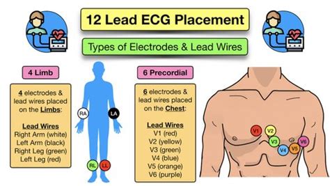 12 Lead ECG Placement: Diagram and Mnemonic for Limb and Precordial Electrode Location — EZmed