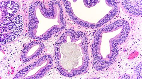 Pathology Outlines - Cystitis cystica and cystitis glandularis