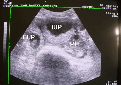 Transabdominal sonography showing intrauterine pregnancy (IUP),... | Download Scientific Diagram