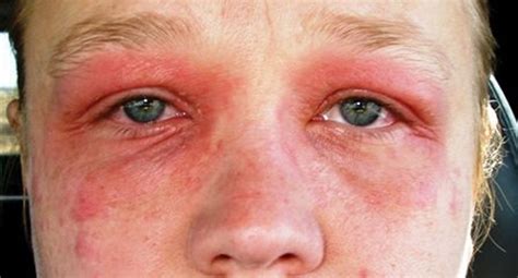 Hay Fever - Causes, Hay Fever Symptoms, Rash, Medication & Treatment