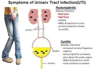 Urinary Tract Infection Treatment - Assignment Point