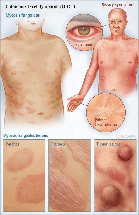 Cutaneous T-Cell Lymphomas | Allergy and Clinical Immunology | JAMA Dermatology | The JAMA Network