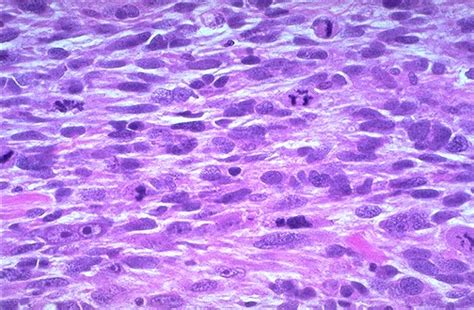 Pathology Outlines - Leiomyosarcoma