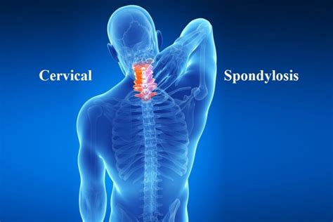 Cervical Degenerative Disc Disease: Causes, Symptoms