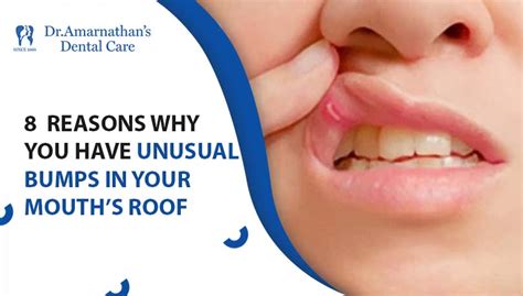 8 reasons why you have unusual bumps in your mouth’s roof