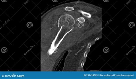 CT Scan of Shoulder Joint in Case Fracture Shoulder Joint Stock Image - Image of fracture ...