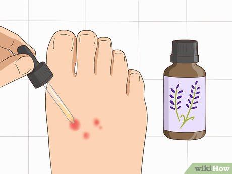 Simple Ways to Stop Gnat Bites from Itching: 11 Steps