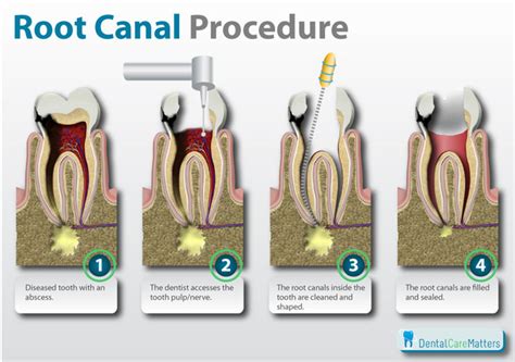 Root Canal Procedure Explained - DentalCareMatters.com