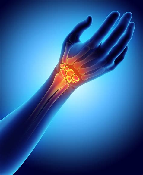 Carpal Tunnel Syndrome - AOA Orthopedic Specialists