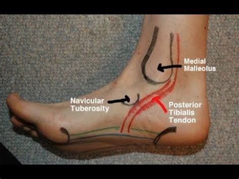 Posterior Tibial Tendinitis Evaluation with Paul Marquis PT - YouTube | Muscles massage, Massage ...