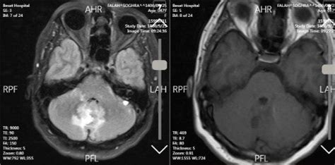 Brain MRI revealed a ventriculoperitoneal shunt, evidence of previous... | Download Scientific ...