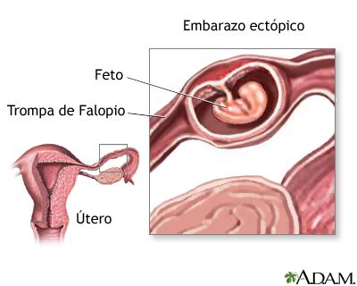 Embarazo ectópico: MedlinePlus enciclopedia médica illustración