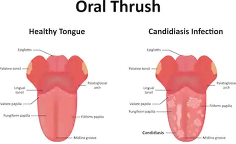 Oral Thrush - Causes, Symptoms, Risk Factors & Home Remedies - Planet Ayurveda