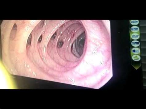 colonoscopy : diverticulosis coli - YouTube