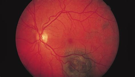 Mushroom-Shaped Choroidal Melanocytoma Mimicking Malignant Melanoma | JAMA Ophthalmology | JAMA ...