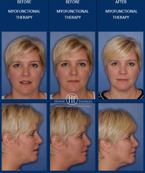 Formal Orofacial Myofunctional Therapy Gallery