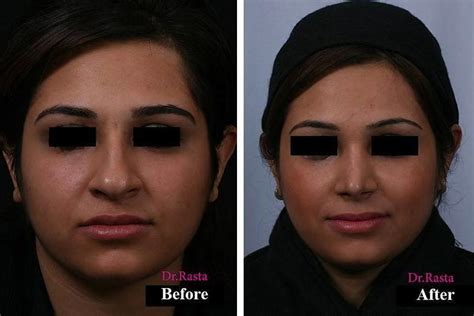 Persian Nose Surgery Photos (8) » Rhinoplasty: Cost, Pics, Reviews, Q&A