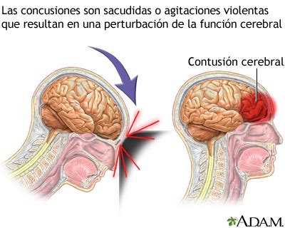 Conmoción cerebral