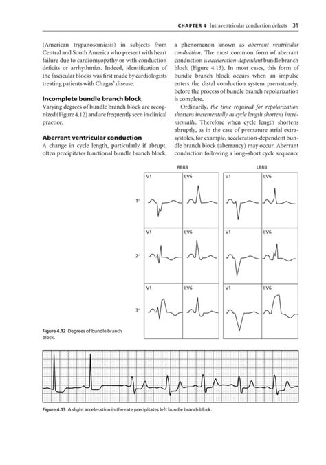 Ecg interpretation