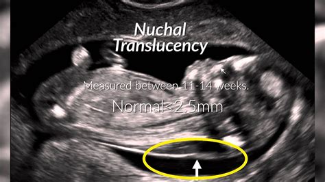 Down Syndrome Symptoms In Ultrasound