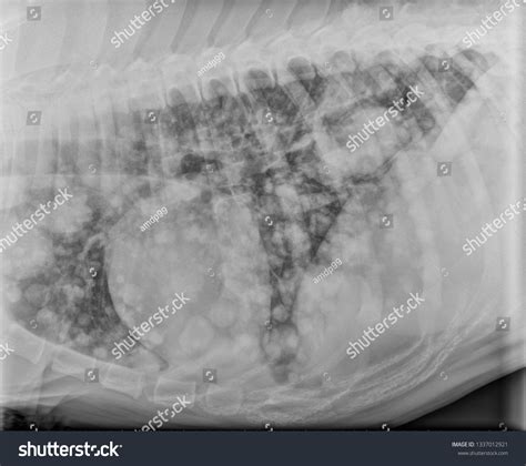 Blastomycosis Lung X Ray