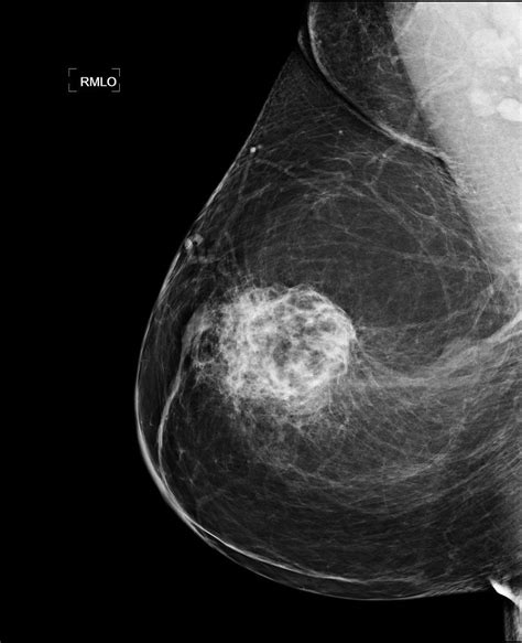 Diagnostic: Mammogram Diagnostic